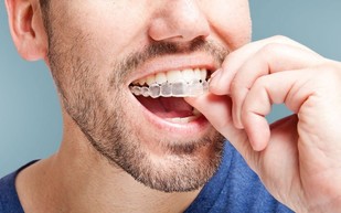 ماذا تعرف عن تقويم الأسنان الشفاف من Invisalign؟