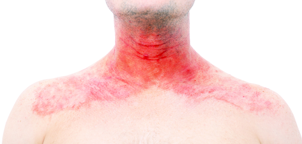 منطقة حمراء بالصدر بها حساسية وتحتاج إلى كريم للحساسية الوجه 